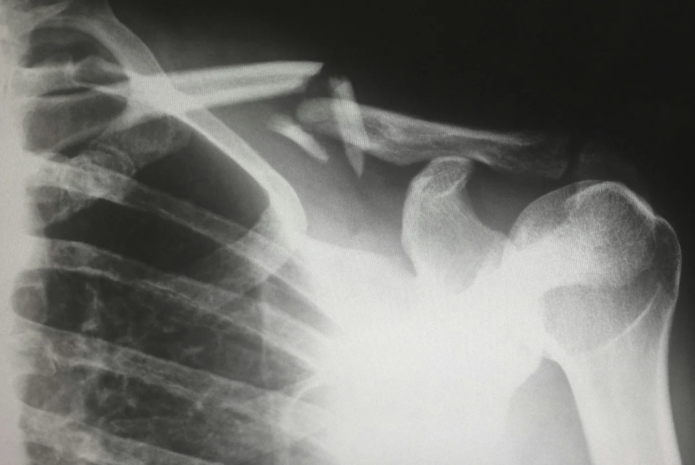 A Lawyer’s Guide to Average Injury Settlements in North Carolina